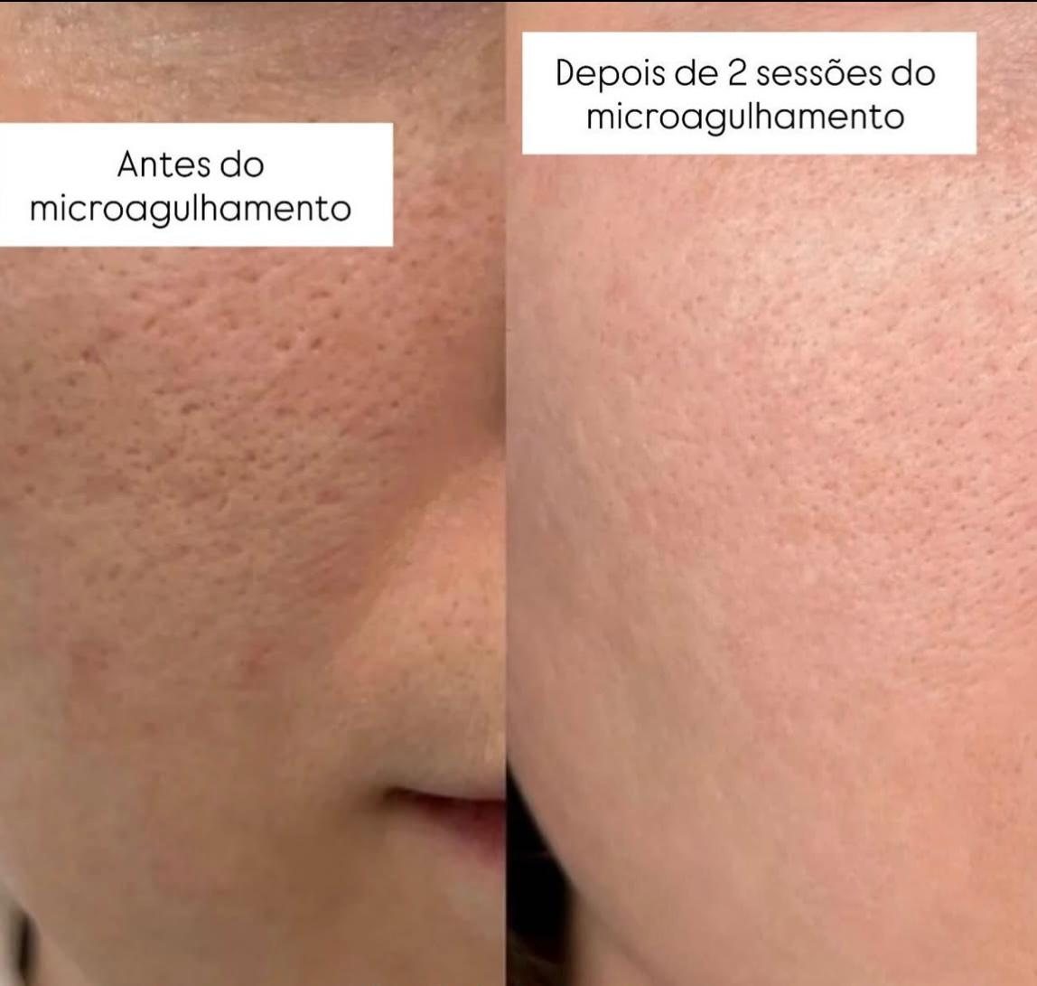 Antes e depois facial 1