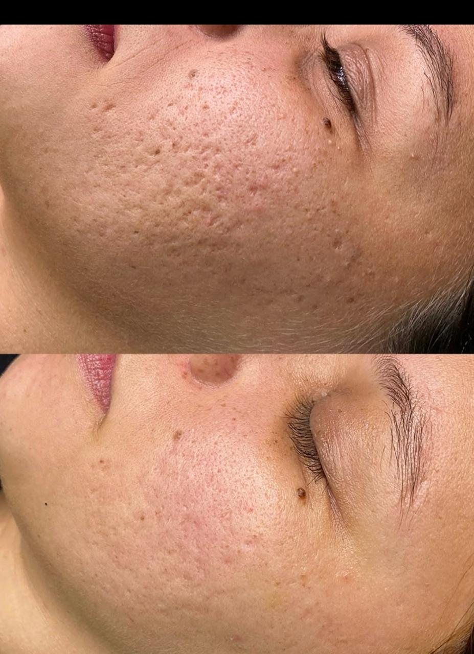 Antes e depois facial 2