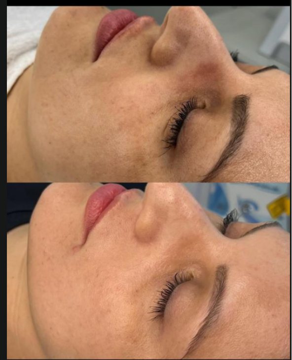 Antes e depois facial 3