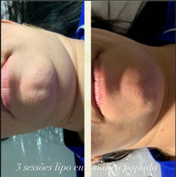 Antes e depois facial 4
